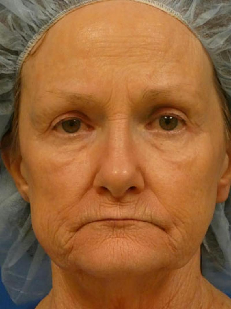 Facelift Before & After Gallery - Patient 255187 - Image 1