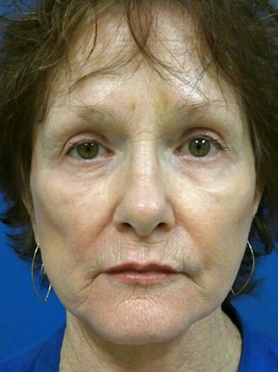 Facelift Before & After Gallery - Patient 255187 - Image 2