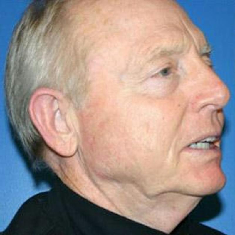 Facelift Before & After Gallery - Patient 529006 - Image 1