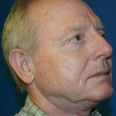 Facelift Before & After Gallery - Patient 529006 - Image 2