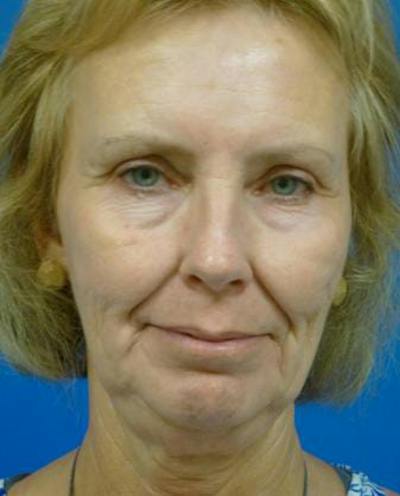 Facelift Before & After Gallery - Patient 223181 - Image 1