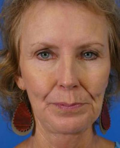 Facelift Before & After Gallery - Patient 223181 - Image 2