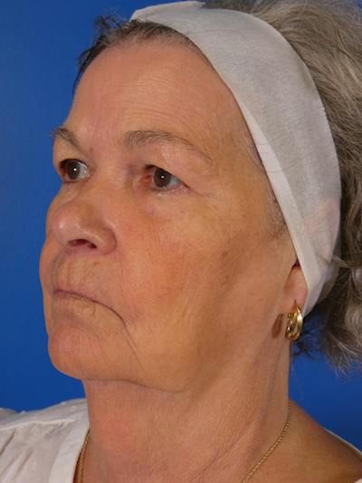 Facelift Before & After Gallery - Patient 200810 - Image 1