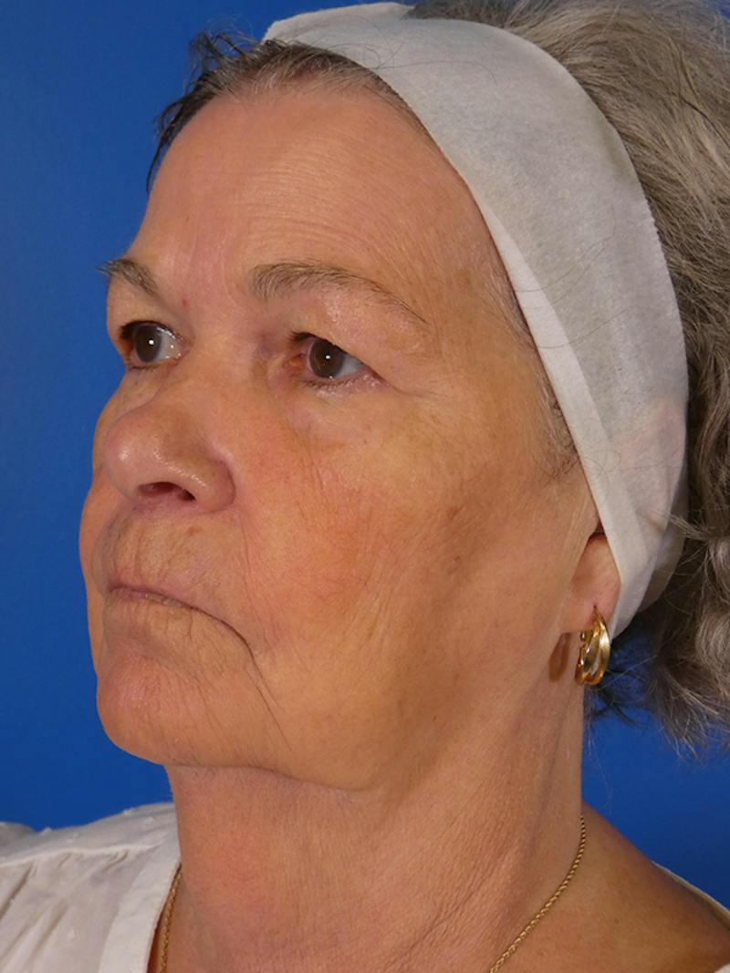 Facelift Before & After Gallery - Patient 200810 - Image 1