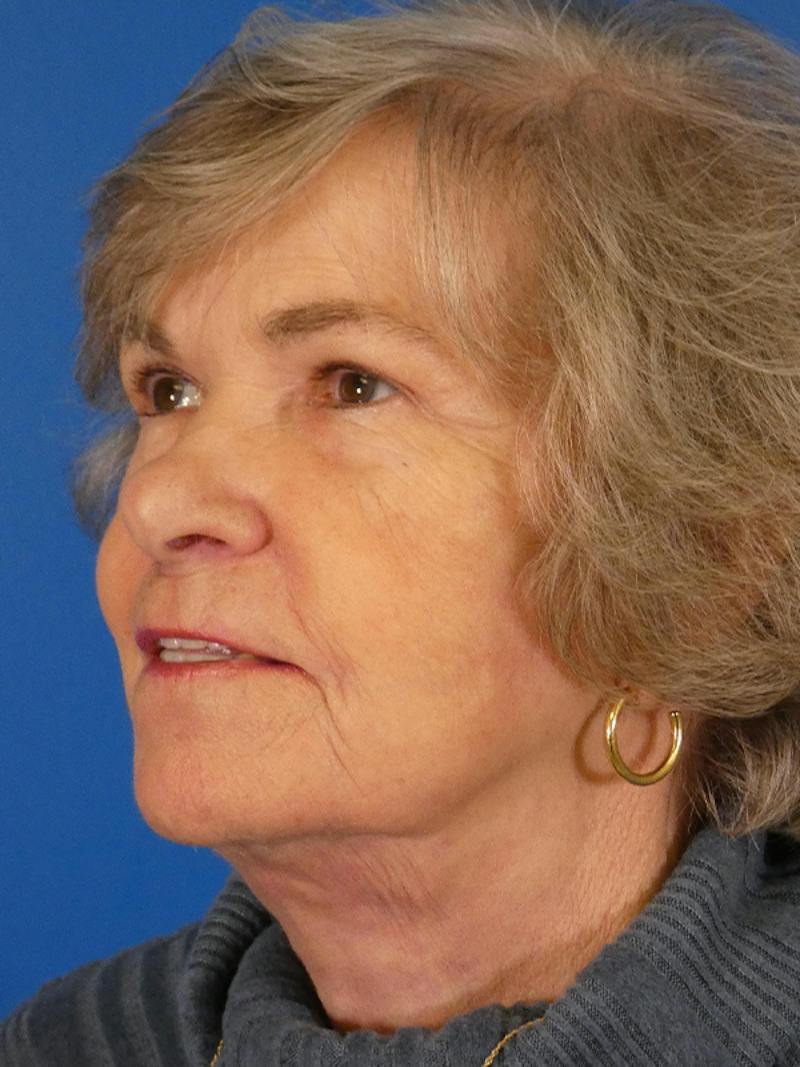 Facelift Before & After Gallery - Patient 200810 - Image 2