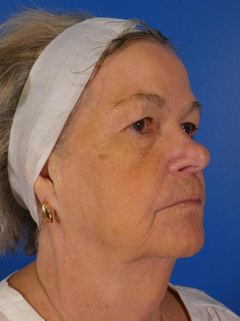 Facelift Before & After Gallery - Patient 200810 - Image 3