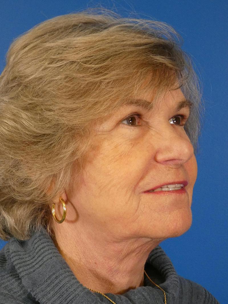 Facelift Before & After Gallery - Patient 200810 - Image 4