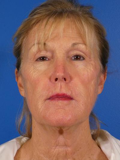Facelift Before & After Gallery - Patient 233546 - Image 1