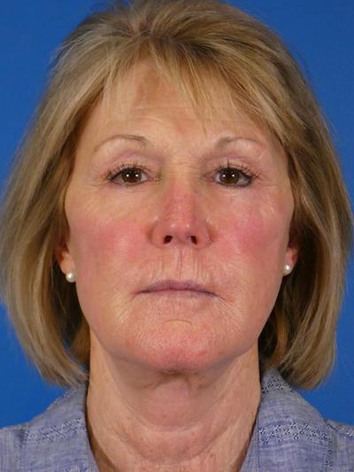 Facelift Before & After Gallery - Patient 233546 - Image 2