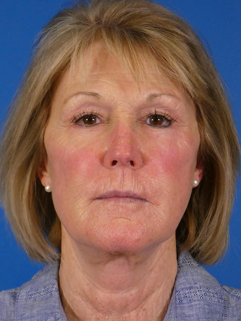 Facelift Before & After Gallery - Patient 233546 - Image 2