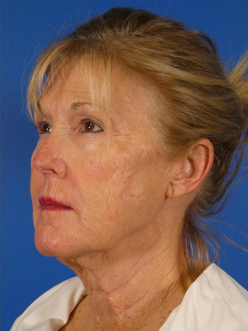 Facelift Before & After Gallery - Patient 233546 - Image 3