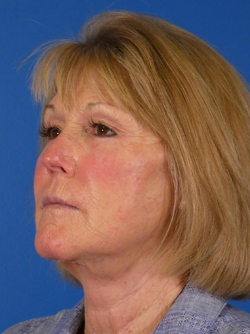 Facelift Before & After Gallery - Patient 233546 - Image 4