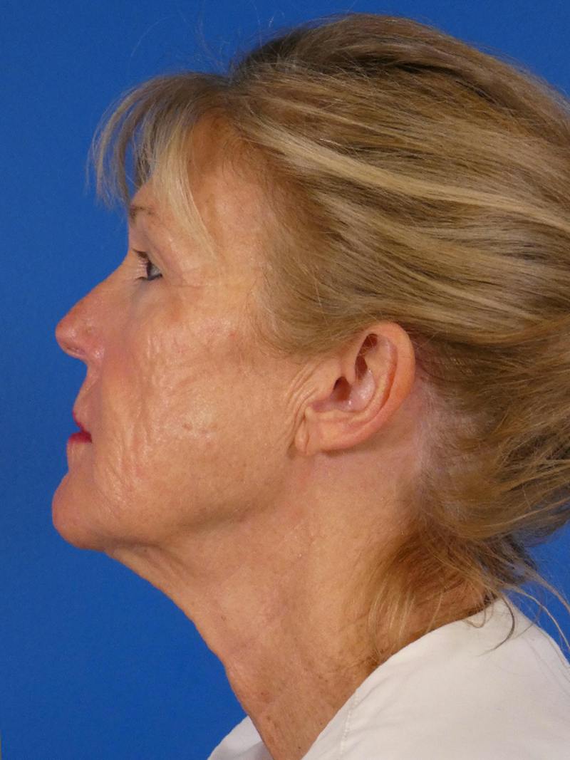 Facelift Before & After Gallery - Patient 233546 - Image 5