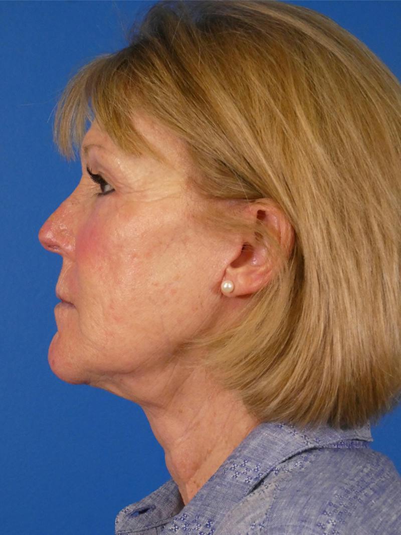Facelift Before & After Gallery - Patient 233546 - Image 6