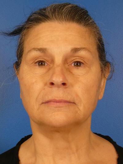 Facelift Before & After Gallery - Patient 289080 - Image 1