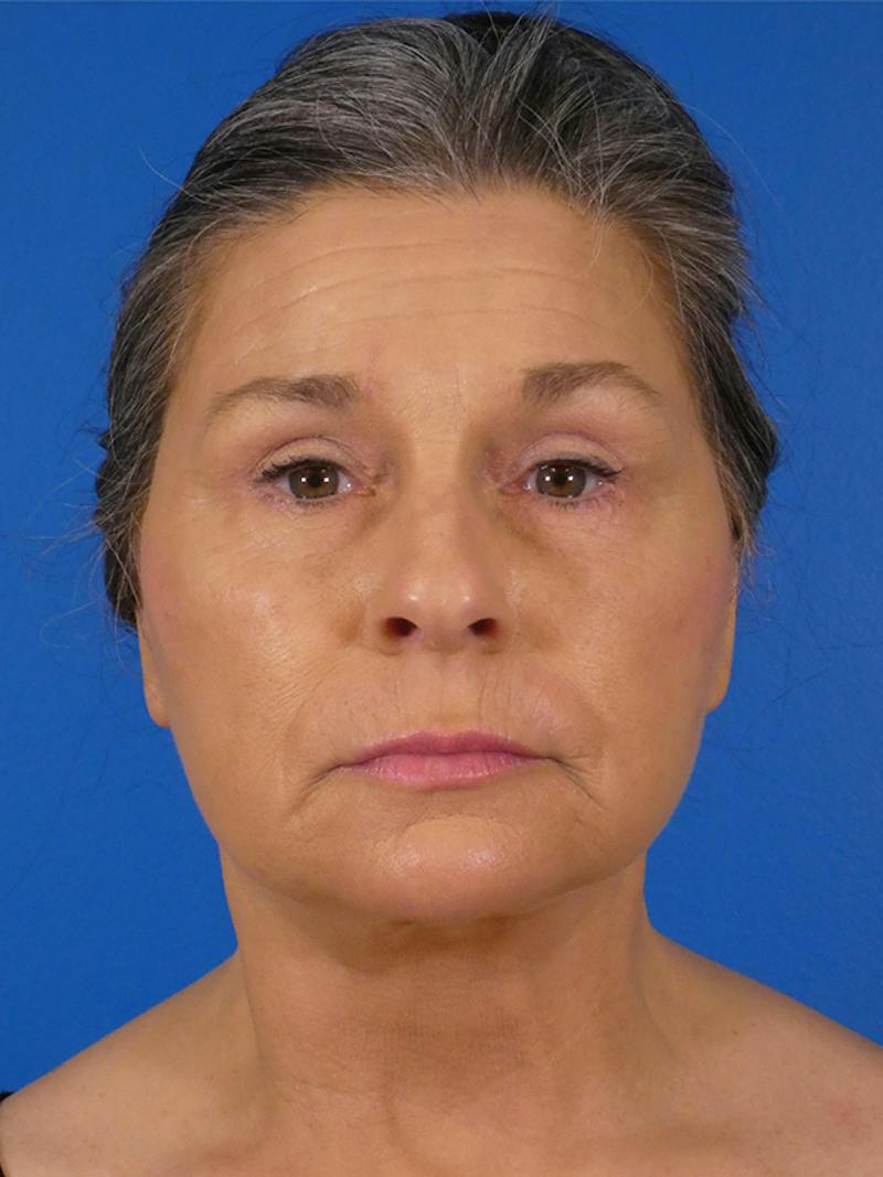 Facelift Before & After Gallery - Patient 289080 - Image 2