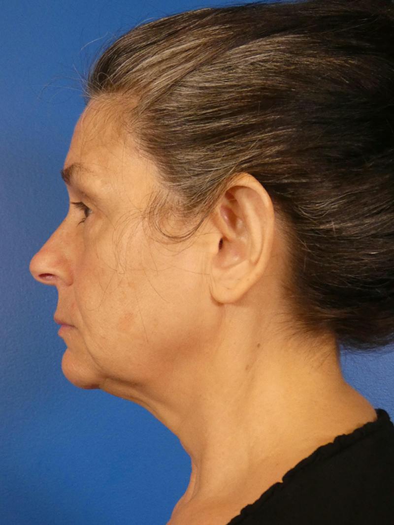 Facelift Before & After Gallery - Patient 289080 - Image 3