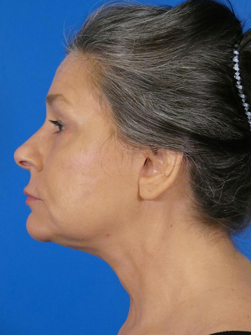 Facelift Before & After Gallery - Patient 289080 - Image 4