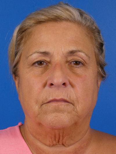 Facelift Before & After Gallery - Patient 348849 - Image 1