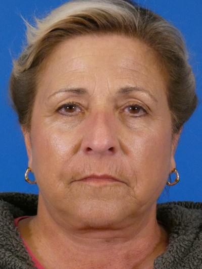 Facelift Before & After Gallery - Patient 348849 - Image 2