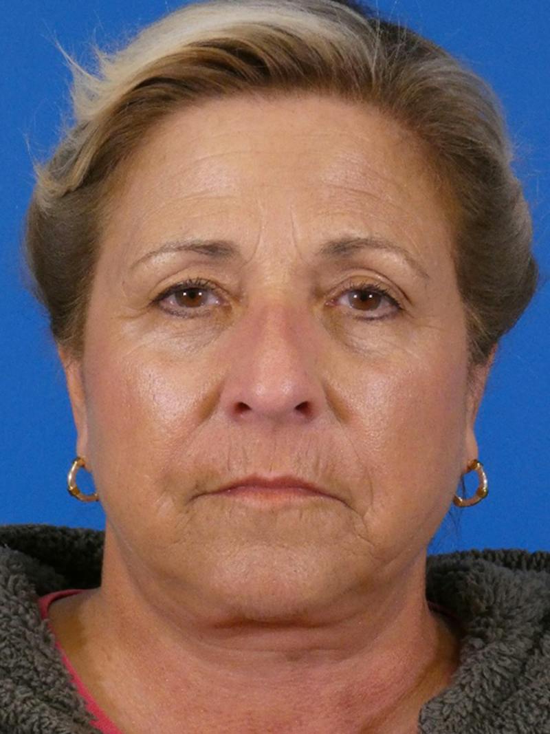 Facelift Before & After Gallery - Patient 348849 - Image 2