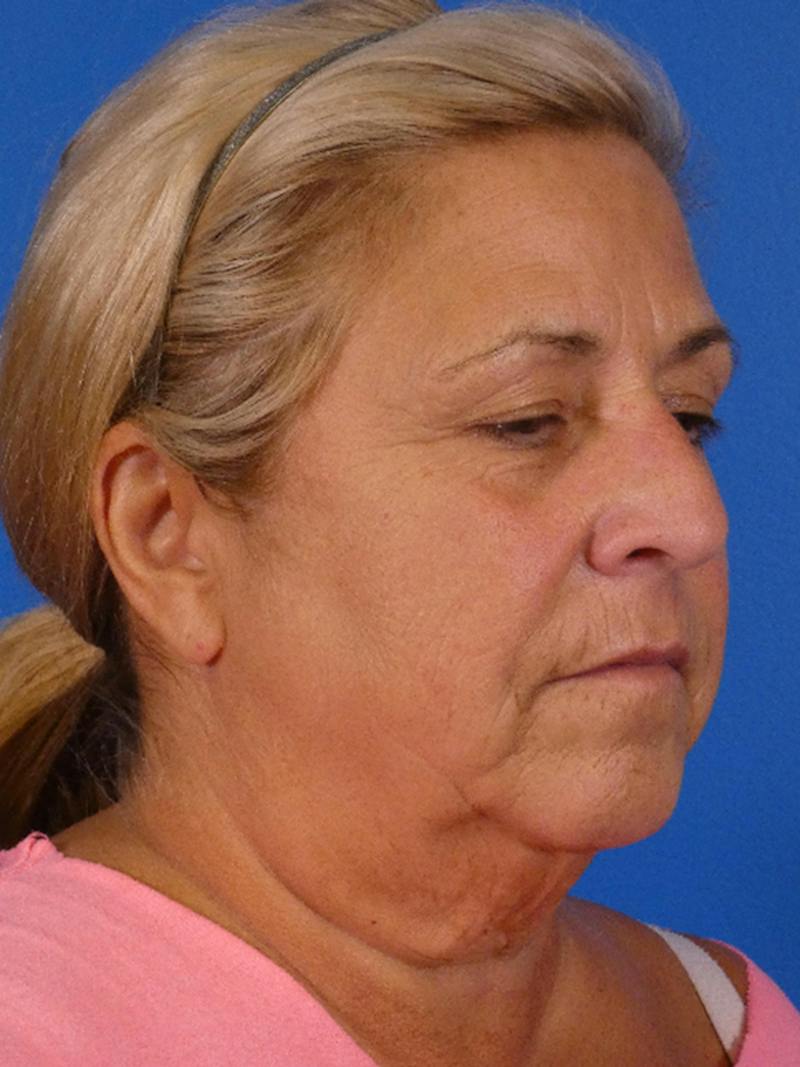 Facelift Before & After Gallery - Patient 348849 - Image 3