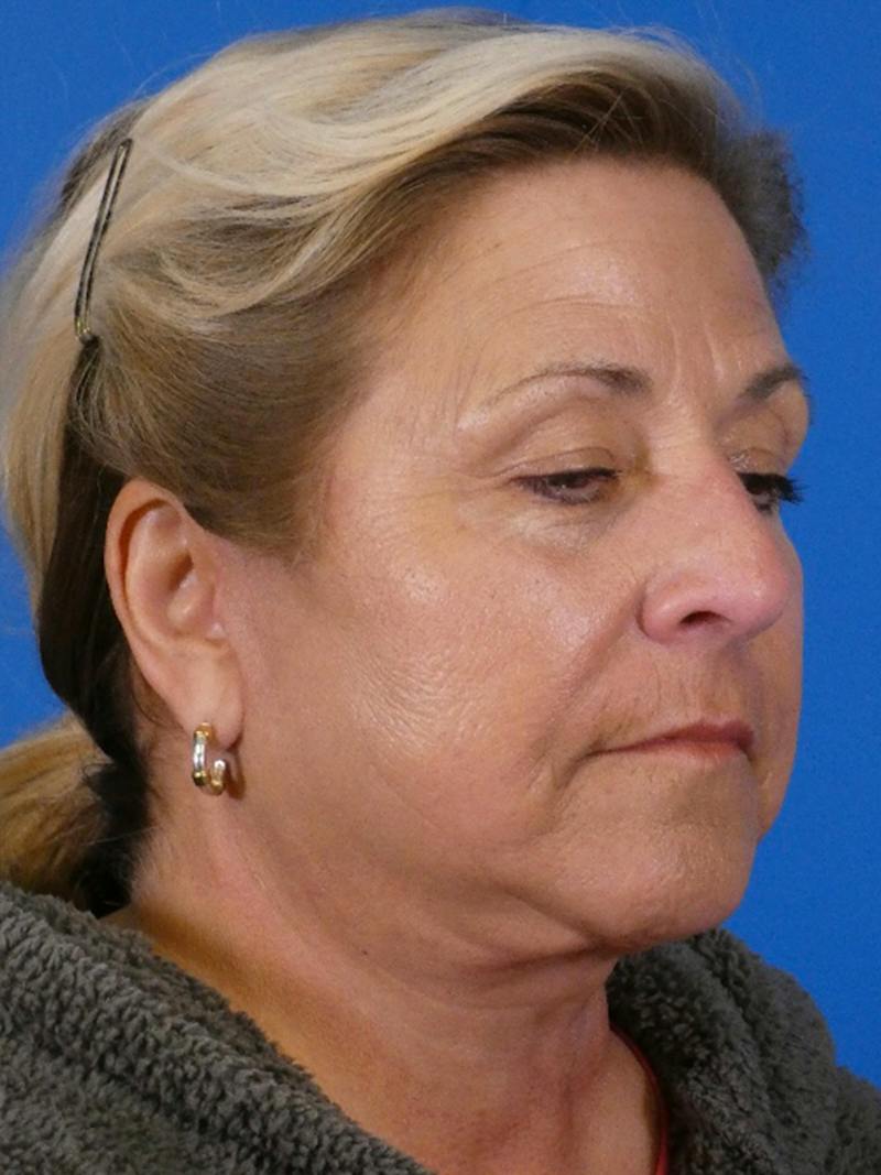 Facelift Before & After Gallery - Patient 348849 - Image 4