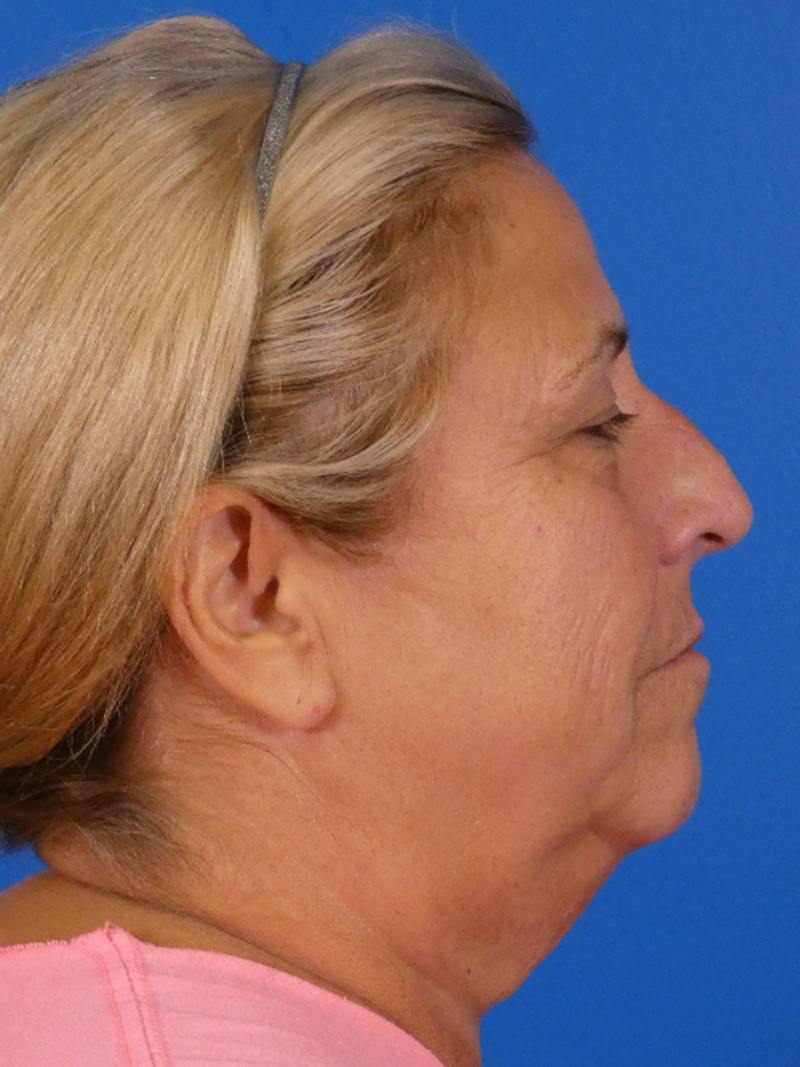 Facelift Before & After Gallery - Patient 348849 - Image 5