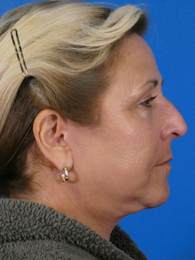 Facelift Before & After Gallery - Patient 348849 - Image 6