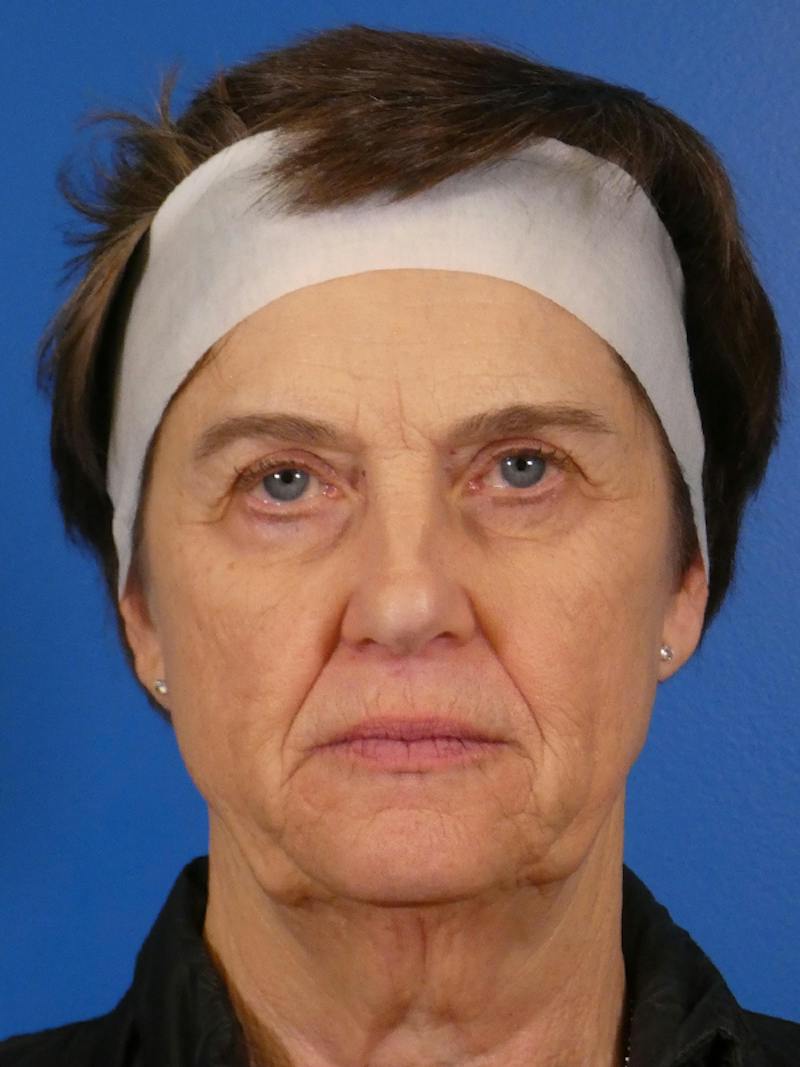 Facelift Before & After Gallery - Patient 151797 - Image 1
