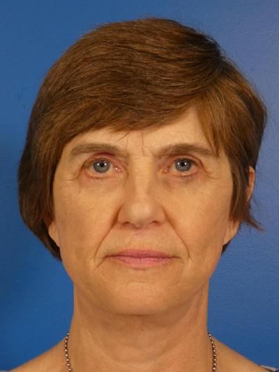 Facelift Before & After Gallery - Patient 151797 - Image 2