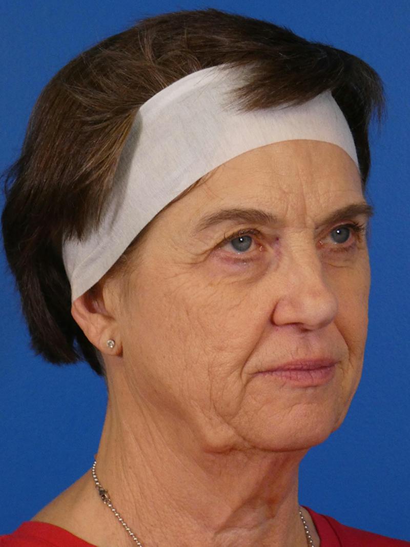 Facelift Before & After Gallery - Patient 151797 - Image 3