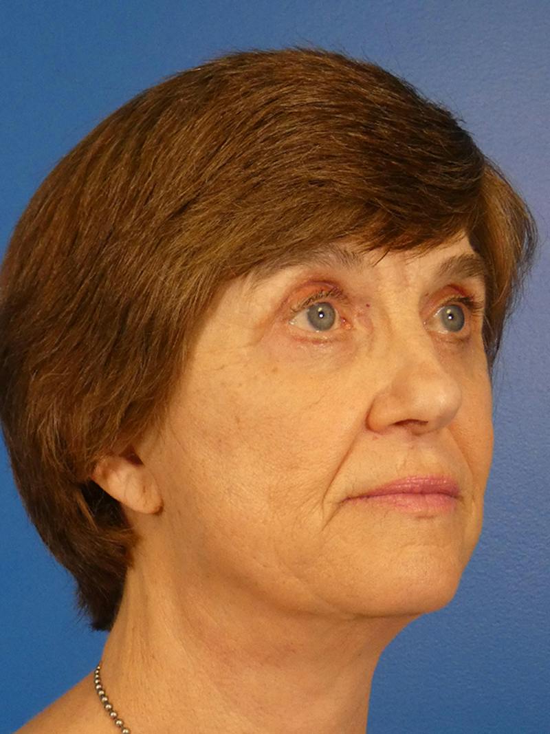 Facelift Before & After Gallery - Patient 151797 - Image 4