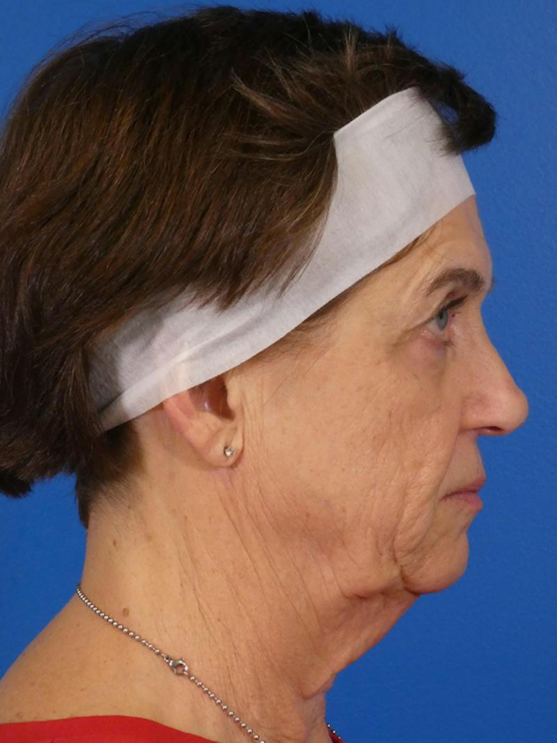 Facelift Before & After Gallery - Patient 151797 - Image 5