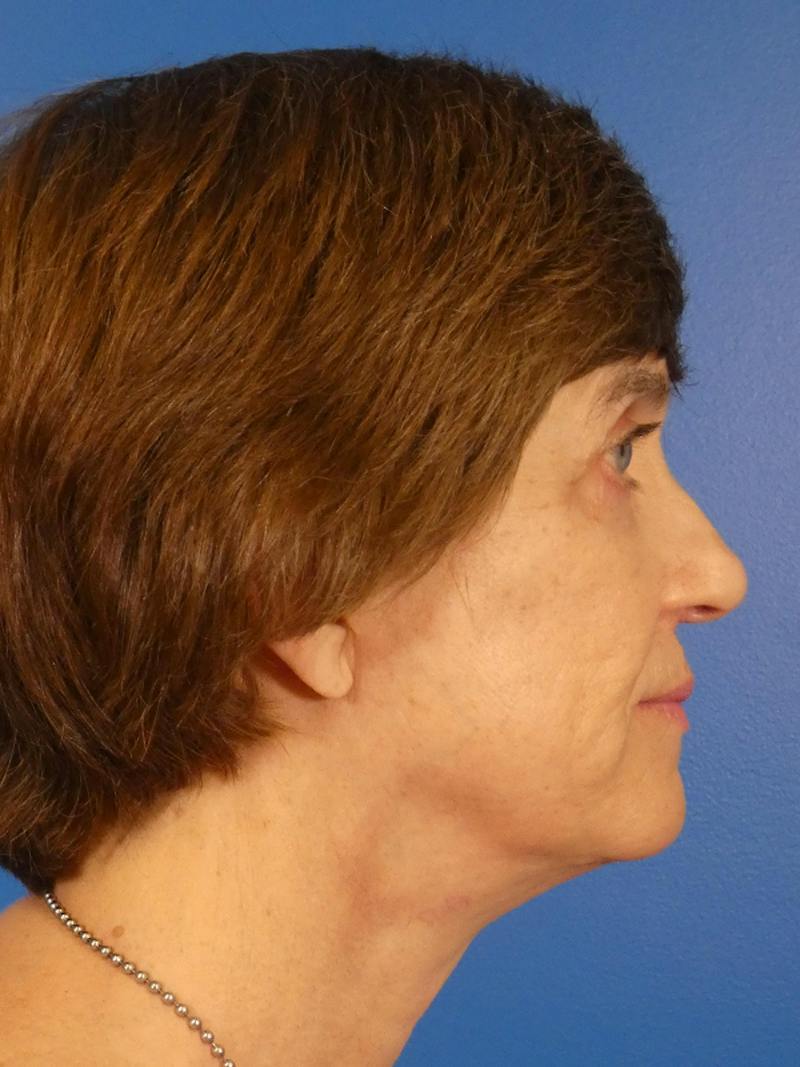 Facelift Before & After Gallery - Patient 151797 - Image 6