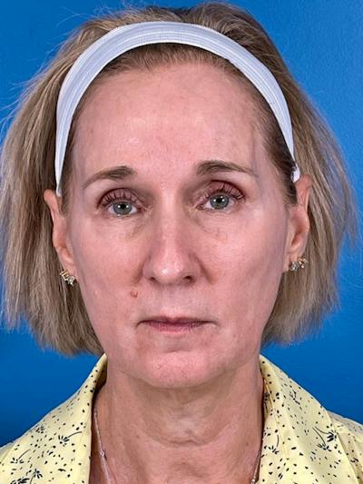 Facelift Before & After Gallery - Patient 309044 - Image 1