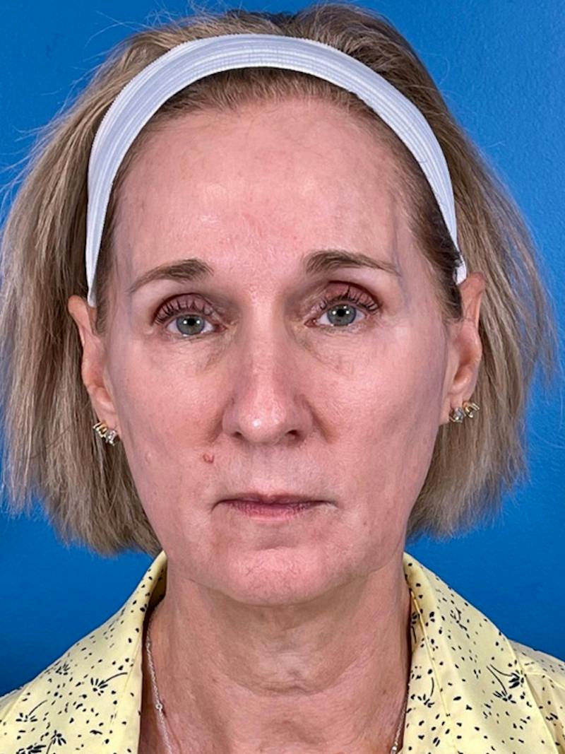 Facelift Before & After Gallery - Patient 309044 - Image 1