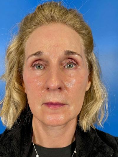 Facelift Before & After Gallery - Patient 309044 - Image 2