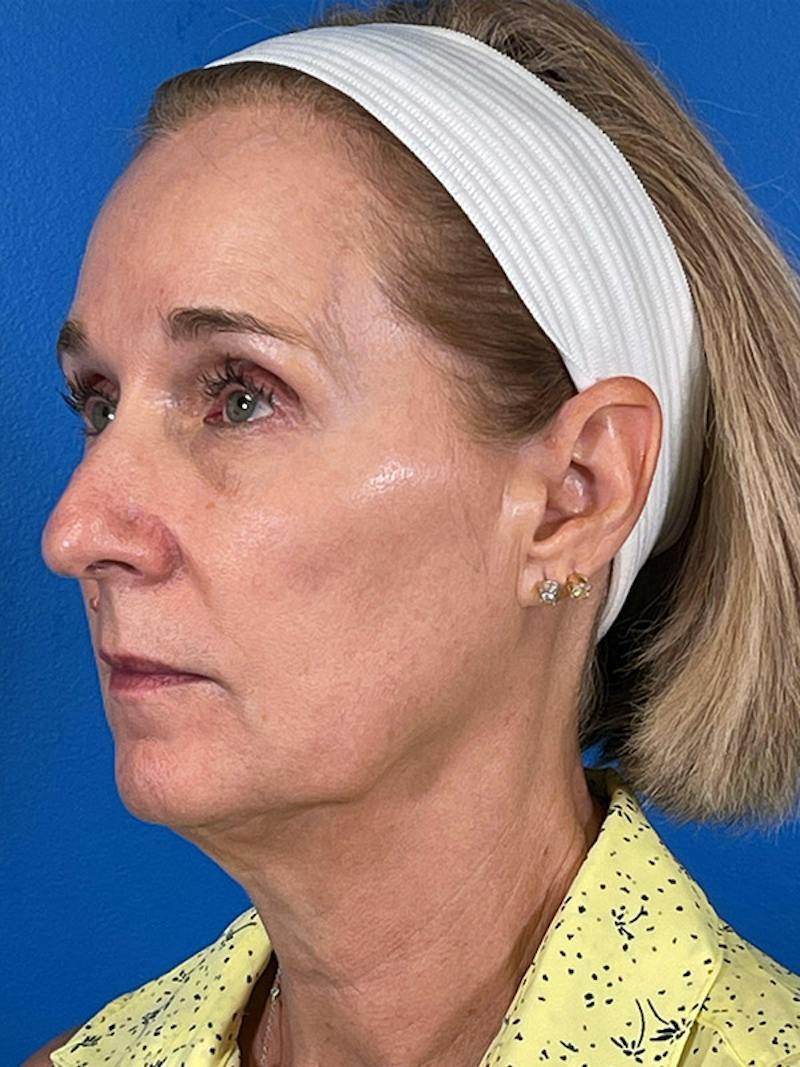 Facelift Before & After Gallery - Patient 309044 - Image 3
