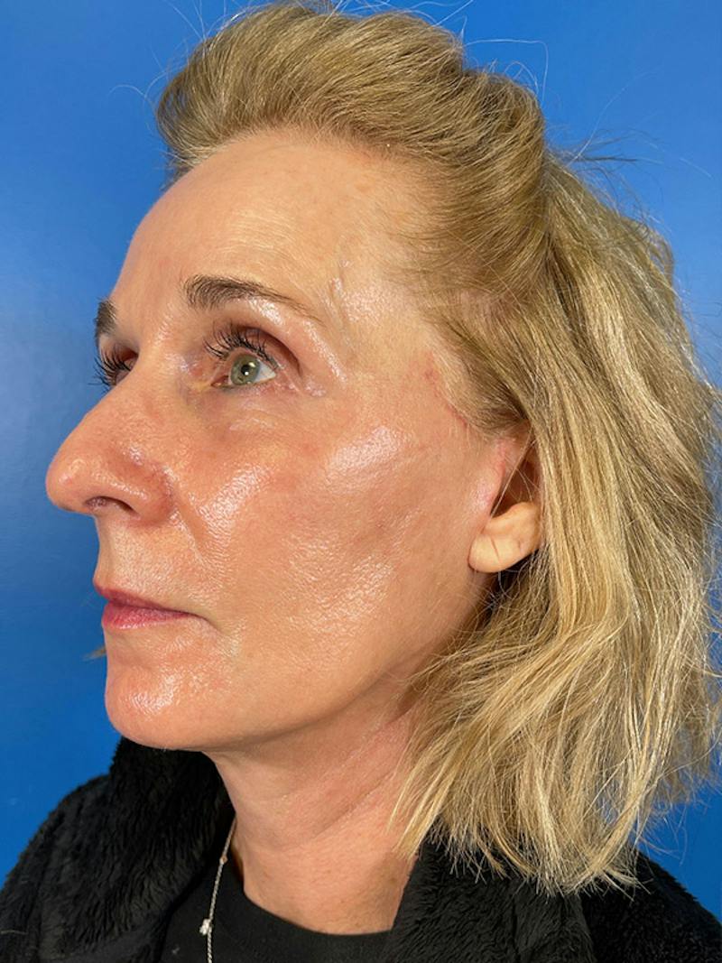 Facelift Before & After Gallery - Patient 309044 - Image 4