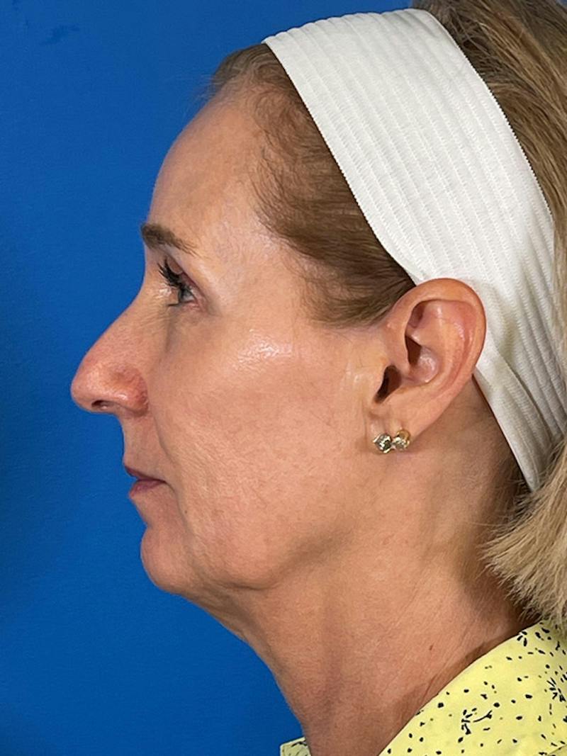 Facelift Before & After Gallery - Patient 309044 - Image 5