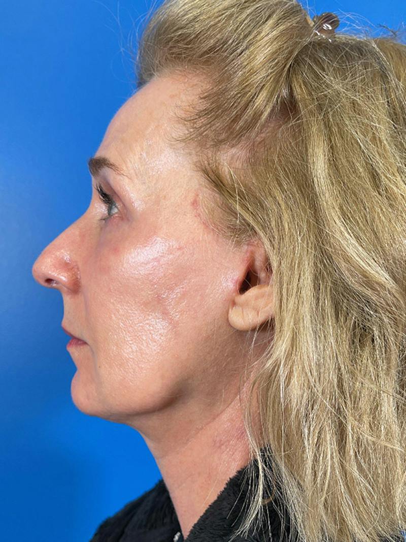 Facelift Before & After Gallery - Patient 309044 - Image 6