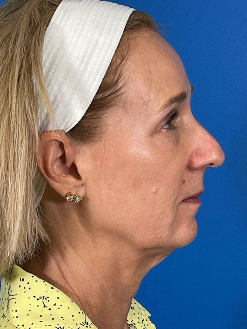 Facelift Before & After Gallery - Patient 309044 - Image 7