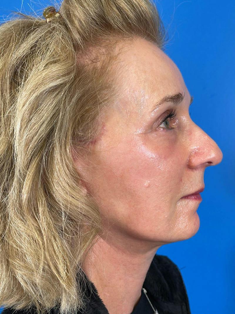 Facelift Before & After Gallery - Patient 309044 - Image 8