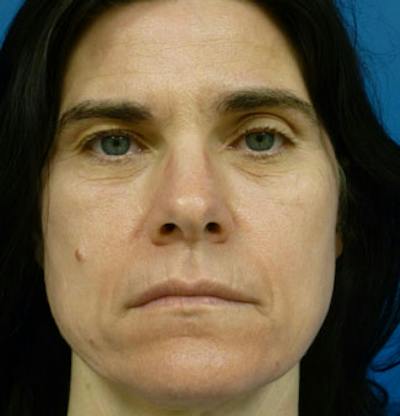 Laser Skin Resurfacing Before & After Gallery - Patient 400907 - Image 1