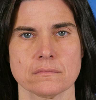 Laser Skin Resurfacing Before & After Gallery - Patient 400907 - Image 2