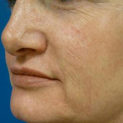 Laser Skin Resurfacing Before & After Gallery - Patient 321006 - Image 1