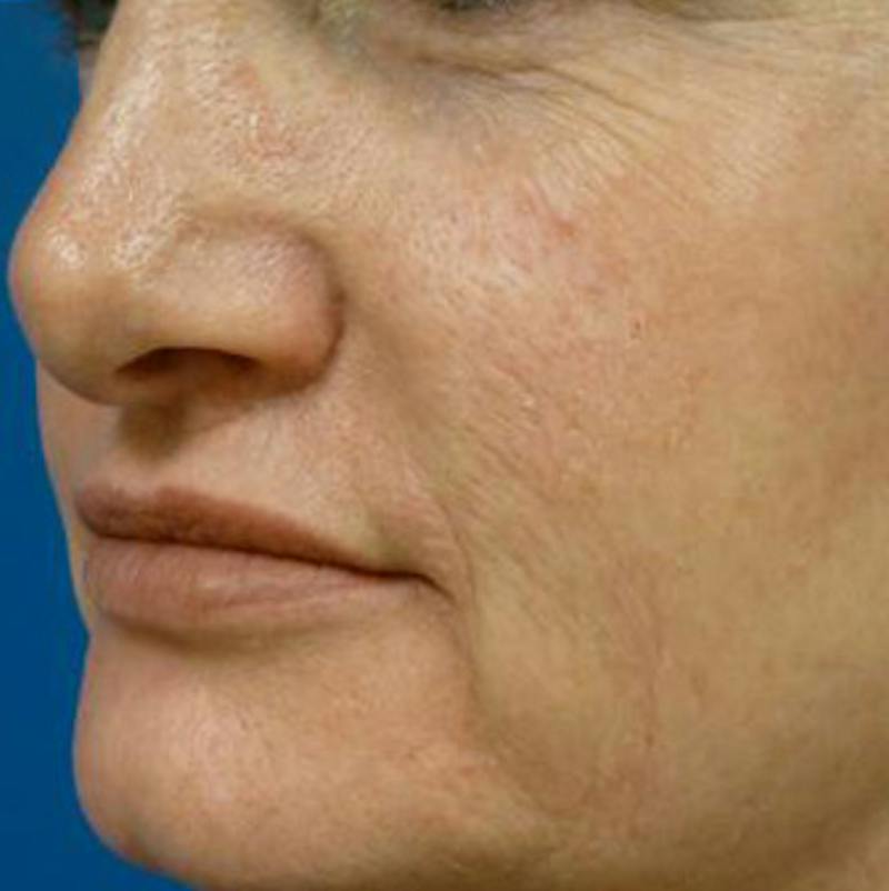 Laser Skin Resurfacing Before & After Gallery - Patient 321006 - Image 1