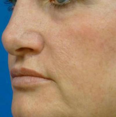 Laser Skin Resurfacing Before & After Gallery - Patient 321006 - Image 2