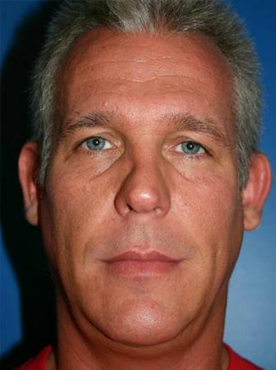 Otoplasty Before & After Gallery - Patient 187418 - Image 1